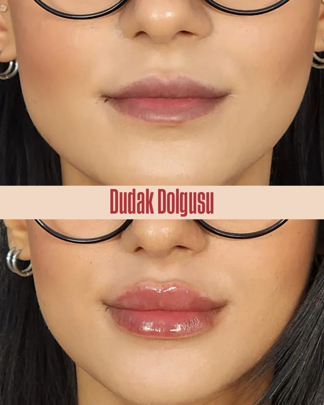 Dudak dolgusu öncesi ve sonrası karşılaştırma